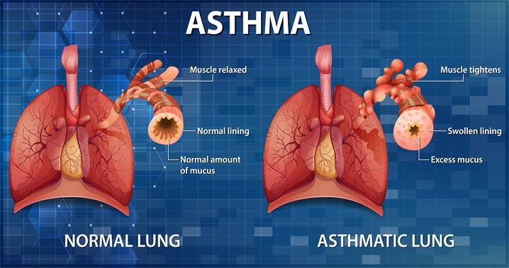 Asthma: Understanding the Disease and Evidence-Based Natural Management Strategies