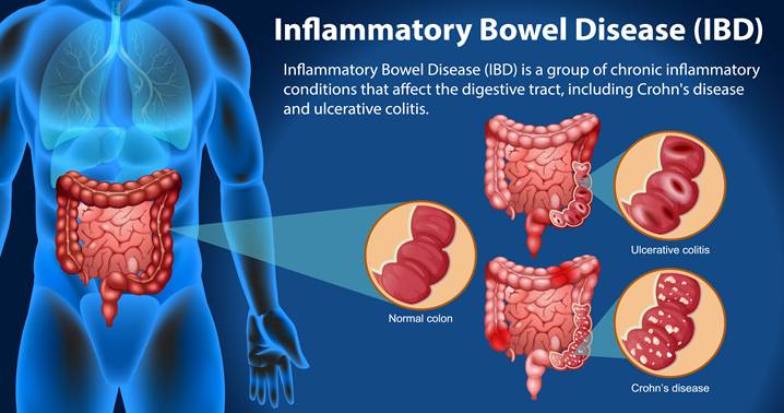 Irritable Bowel Syndrome (IBS): Causes, Symptoms, Diagnosis, and Management