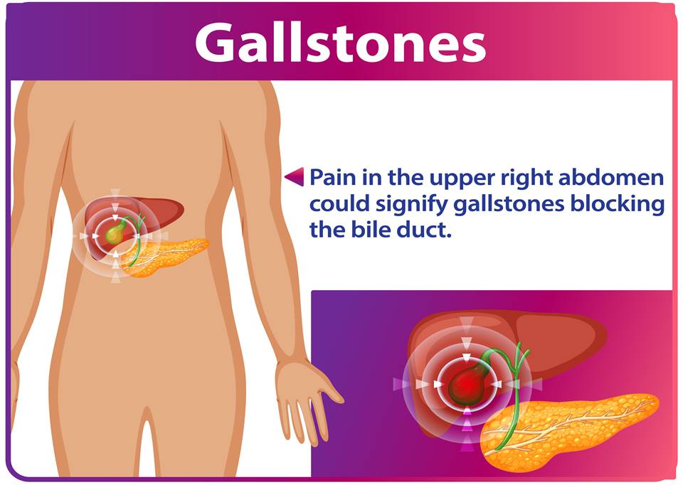 Gallbladder Stones