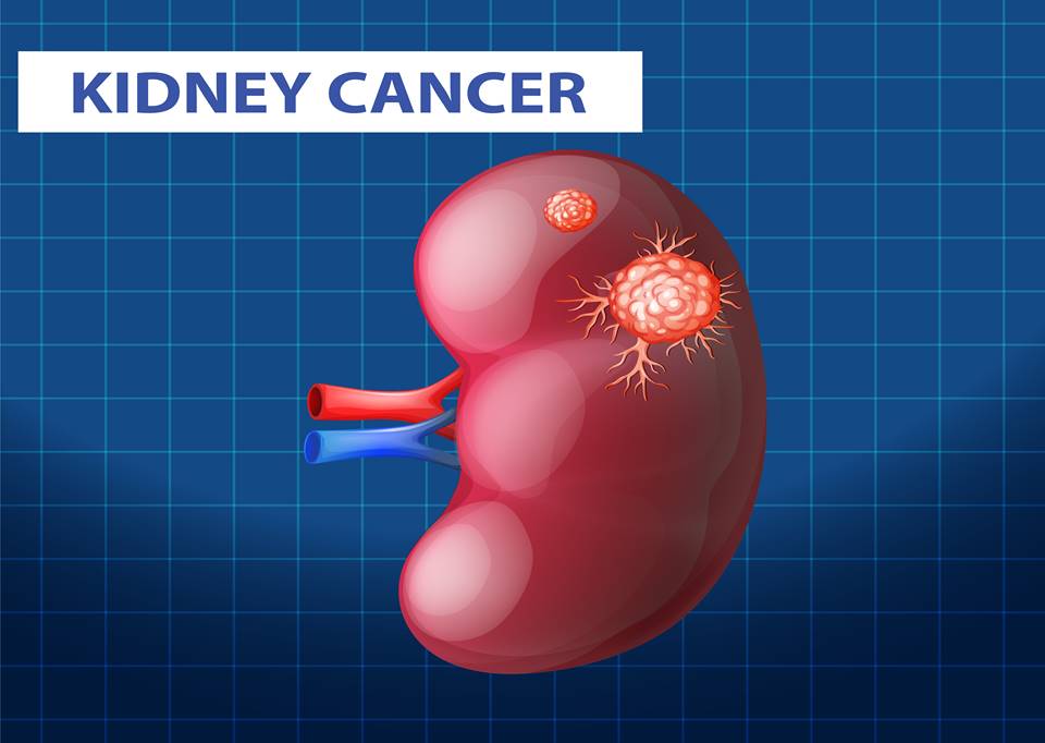 Kidney Cancer
