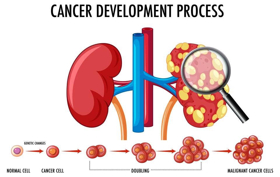 Kidney Cancer