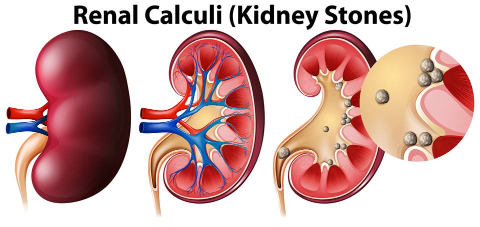 Kidney Stones