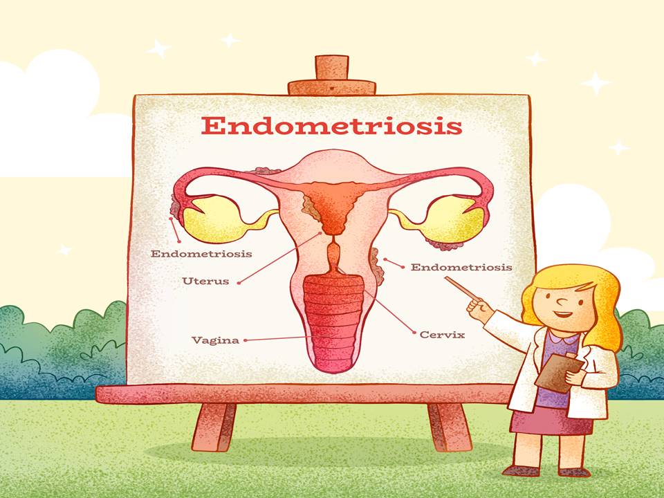Endometriosis