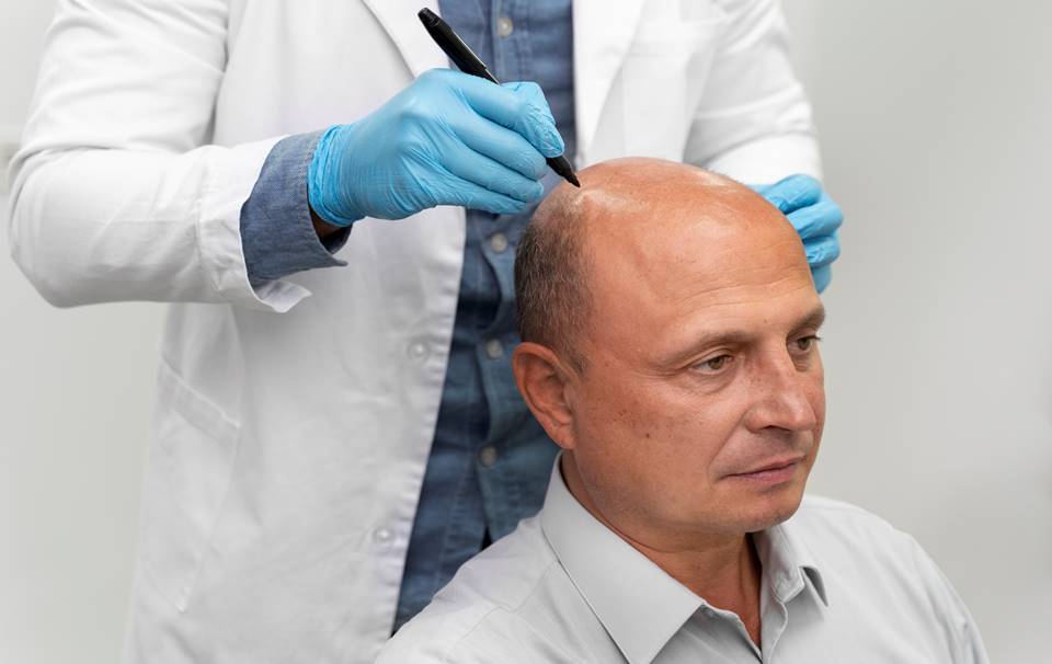 Alopecia