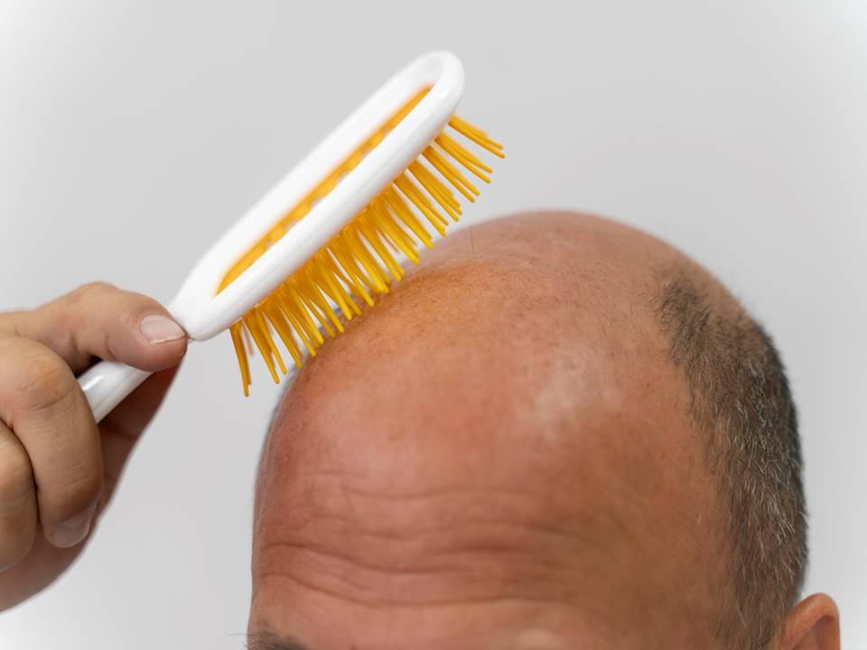 Alopecia