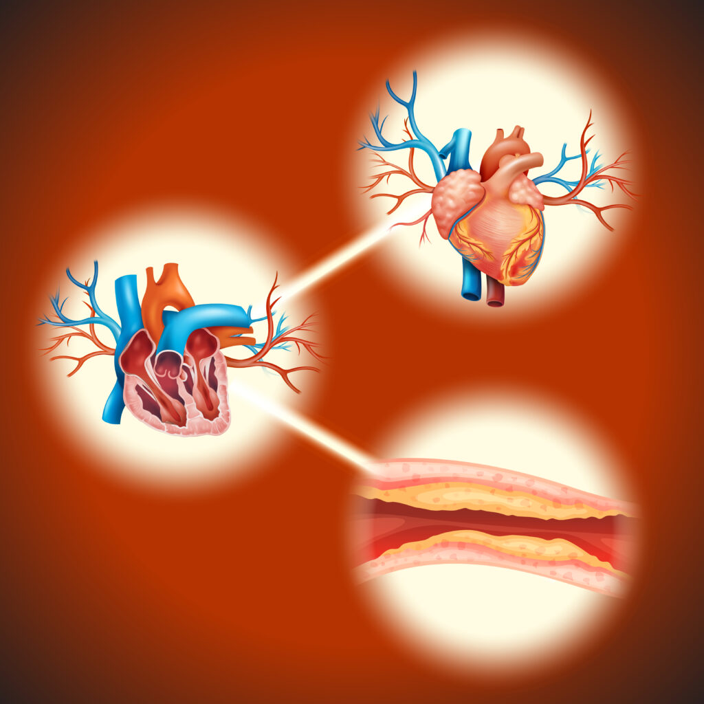 Ischemic Heart Disease